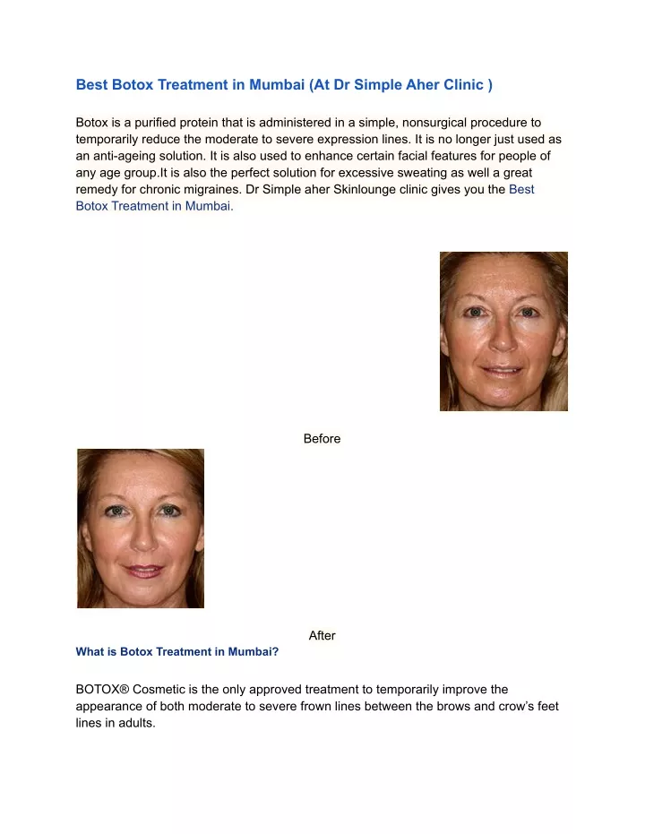 best botox treatment in mumbai at dr simple aher