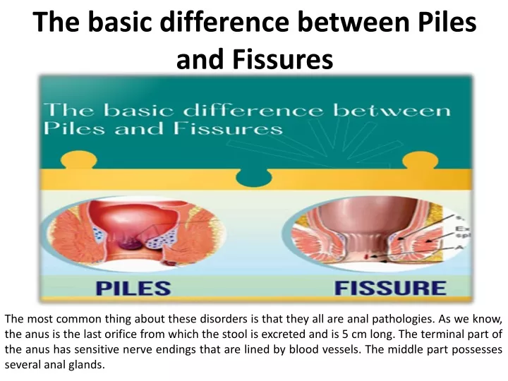 the basic difference between piles and fissures