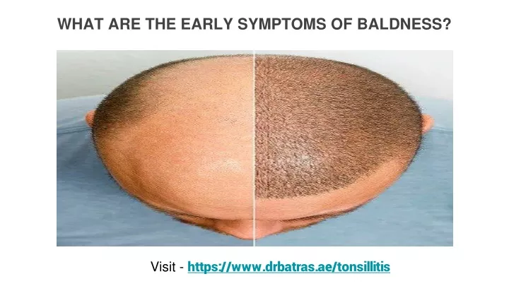 what are the early symptoms of baldness