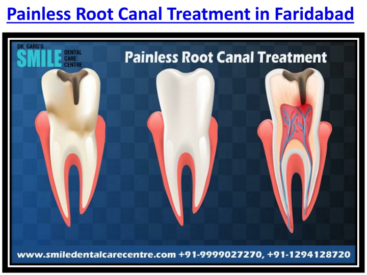 painless root canal treatment in faridabad