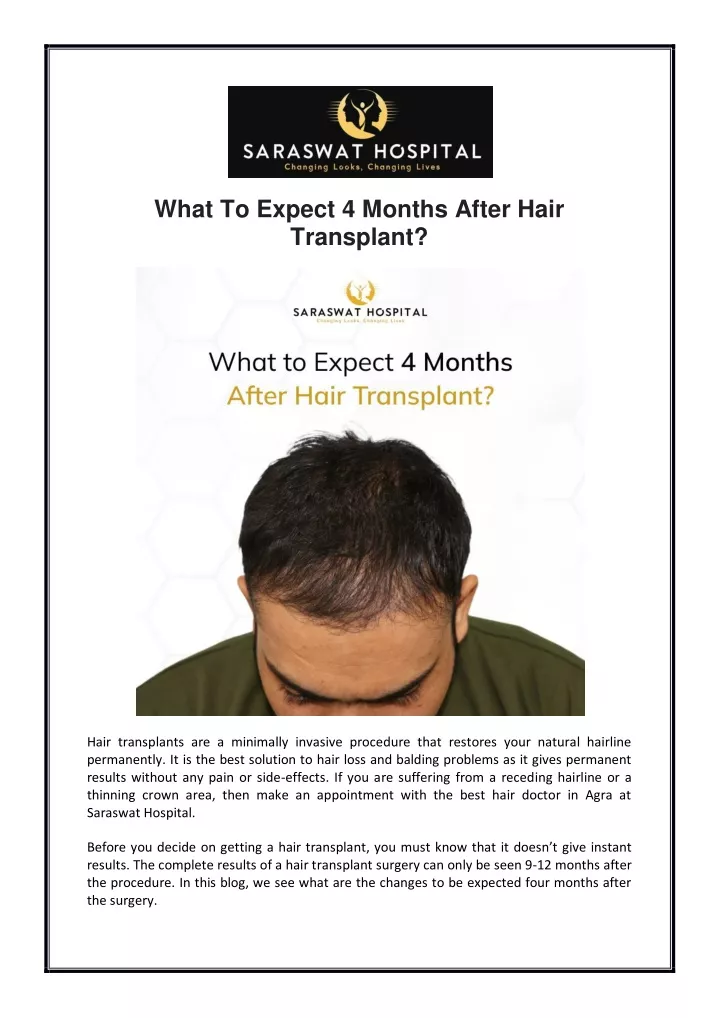 what to expect 4 months after hair transplant