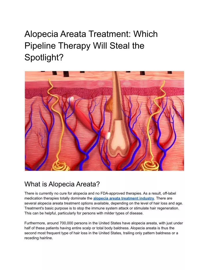 alopecia areata treatment which pipeline therapy