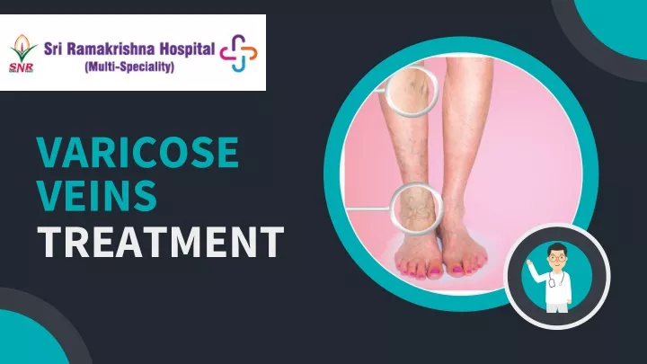 varicose veins treatment