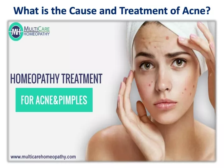 what is the cause and treatment of acne