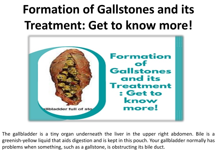 formation of gallstones and its treatment