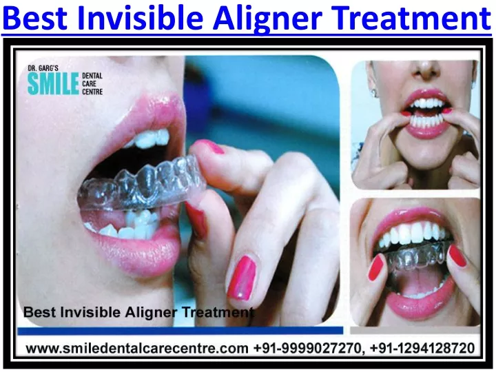 best invisible aligner treatment