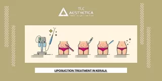 Liposuction treatment in kerala