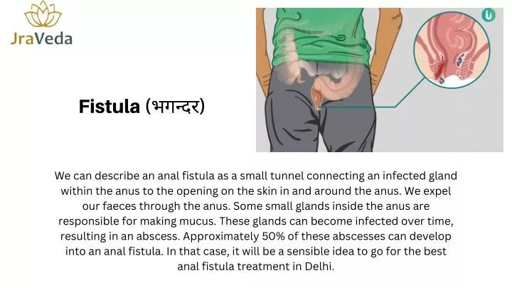 fistula