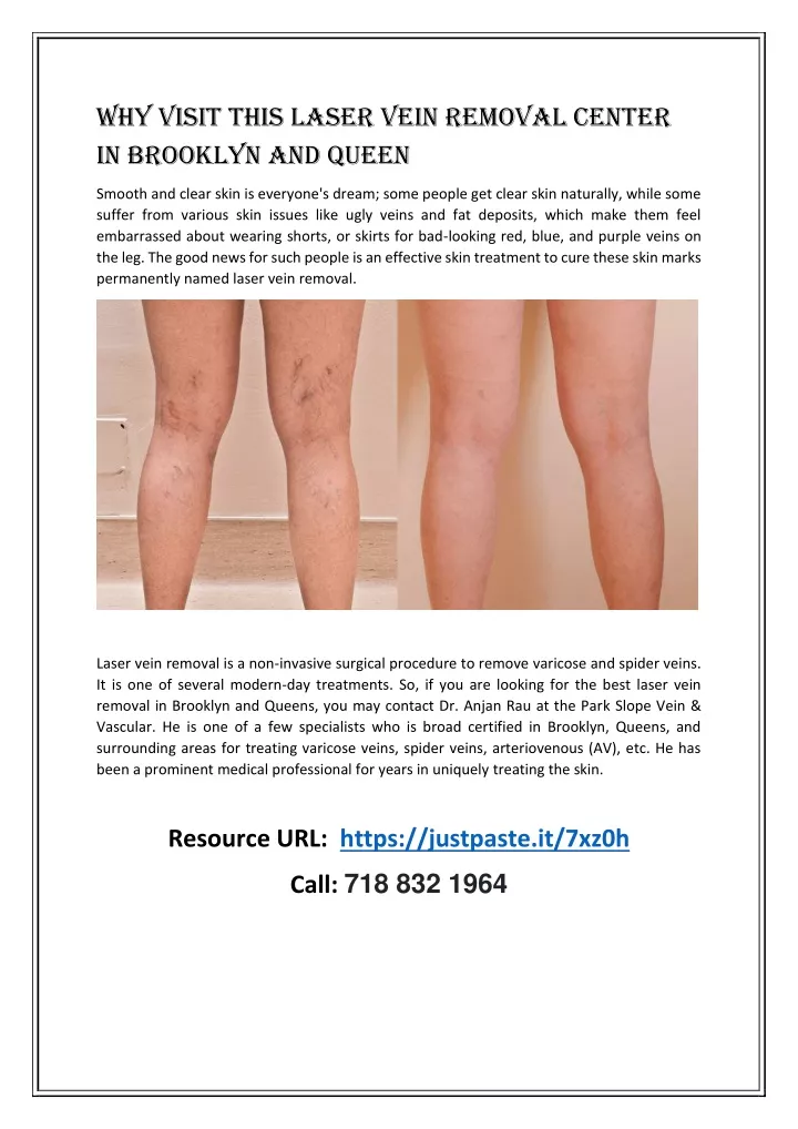 why visit this laser vein removal center