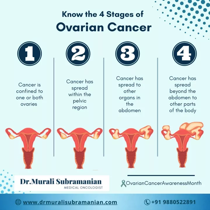 know the 4 stages of ovarian cancer