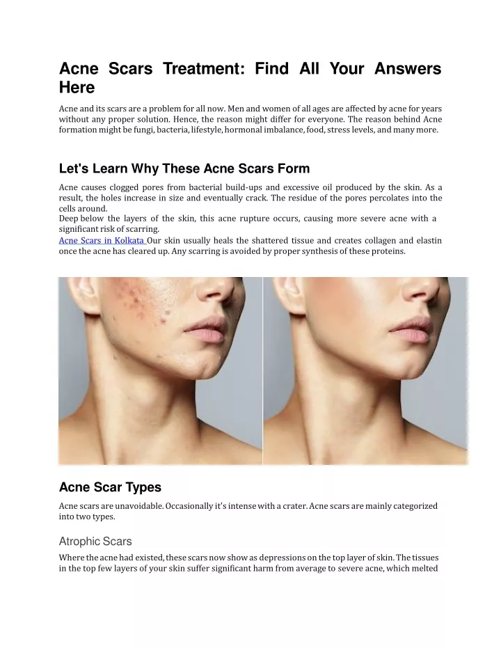 acne scars treatment find all your answers here