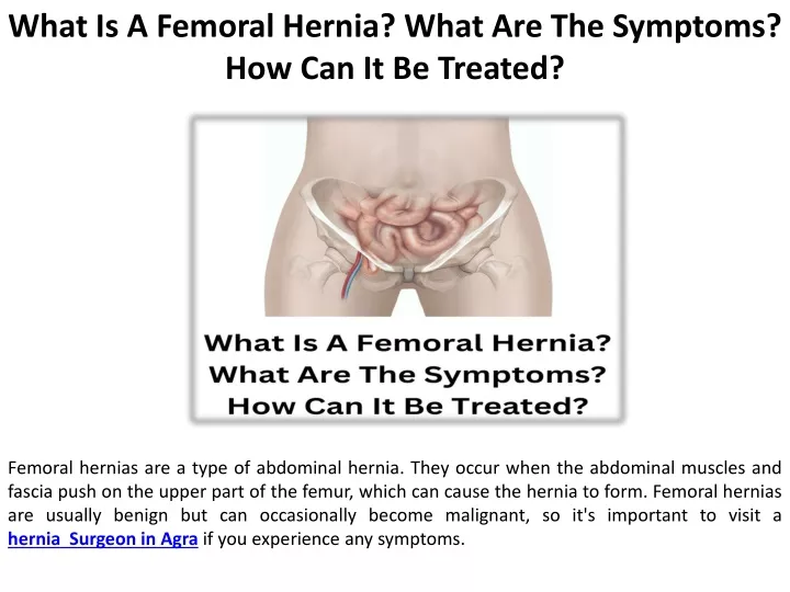 what is a femoral hernia what are the symptoms