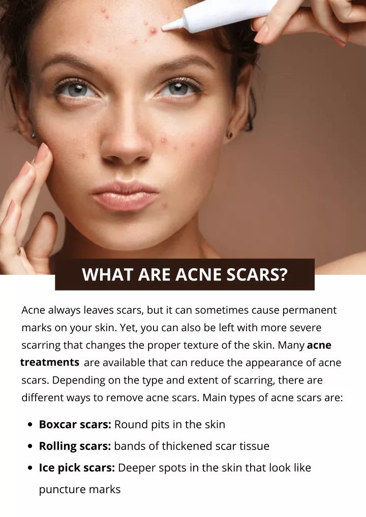 what are acne scars