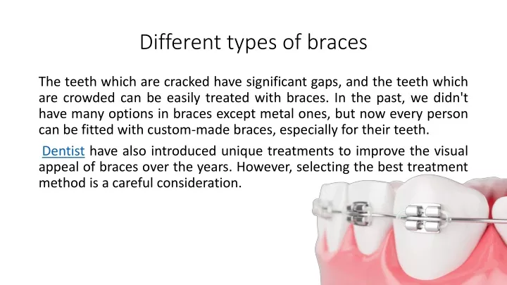 PPT - Different types of braces PowerPoint Presentation, free