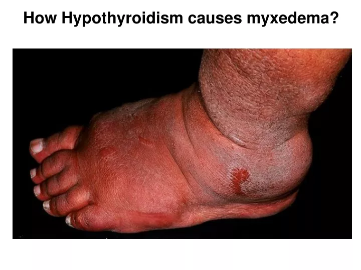 how hypothyroidism causes myxedema