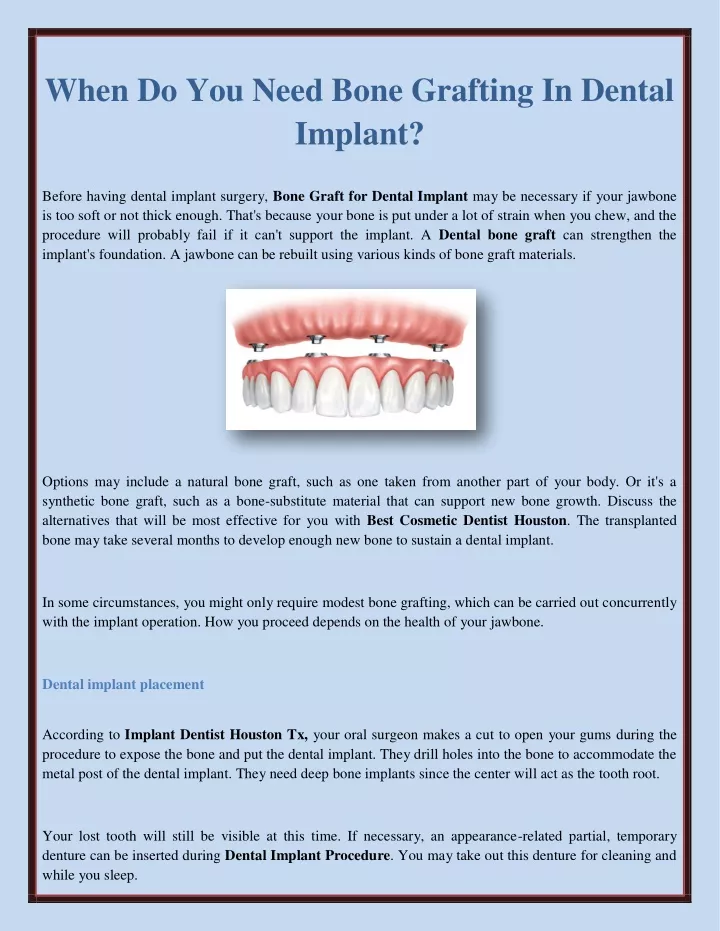 when do you need bone grafting in dental implant
