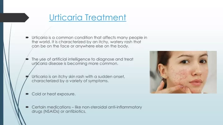 urticaria treatment