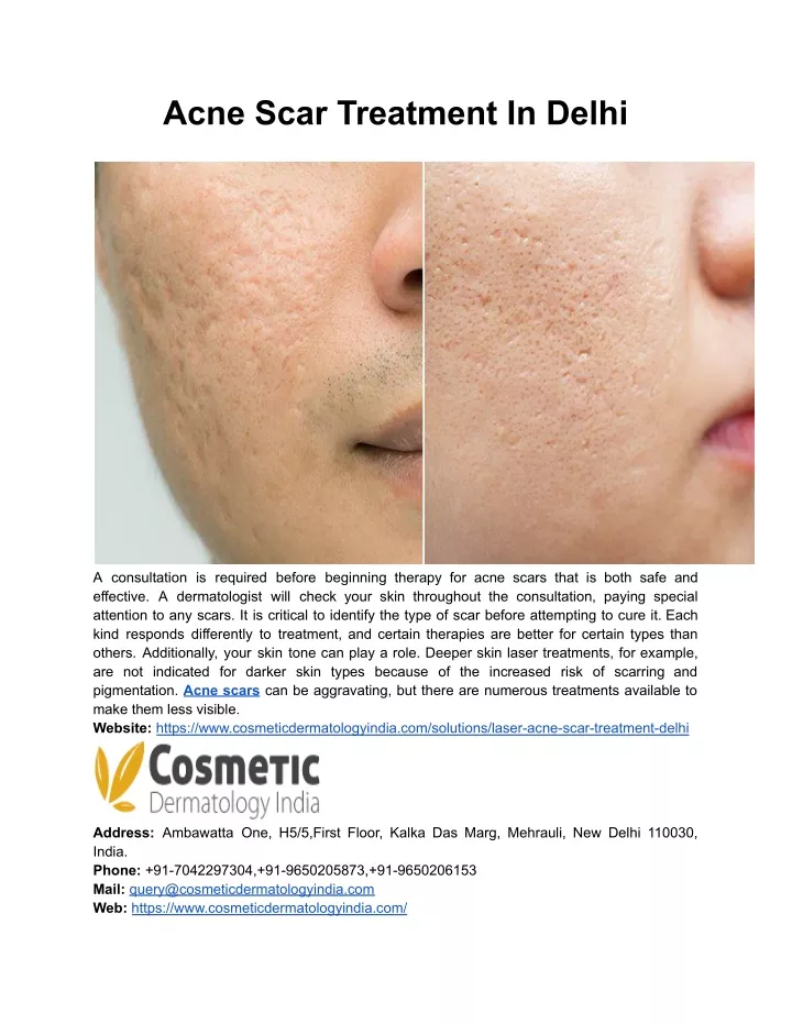 acne scar treatment in delhi