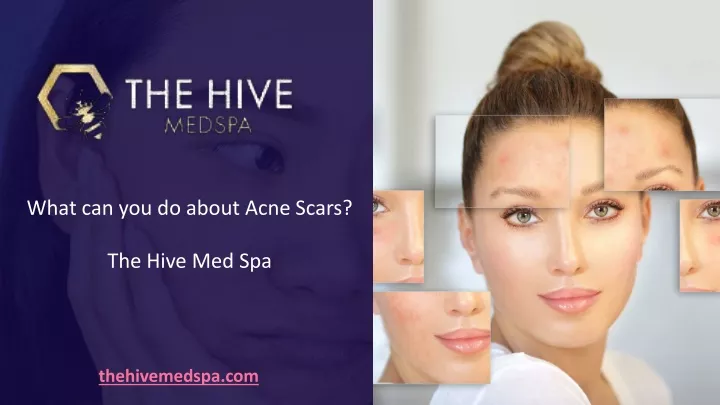 what can you do about acne scars the hive med spa