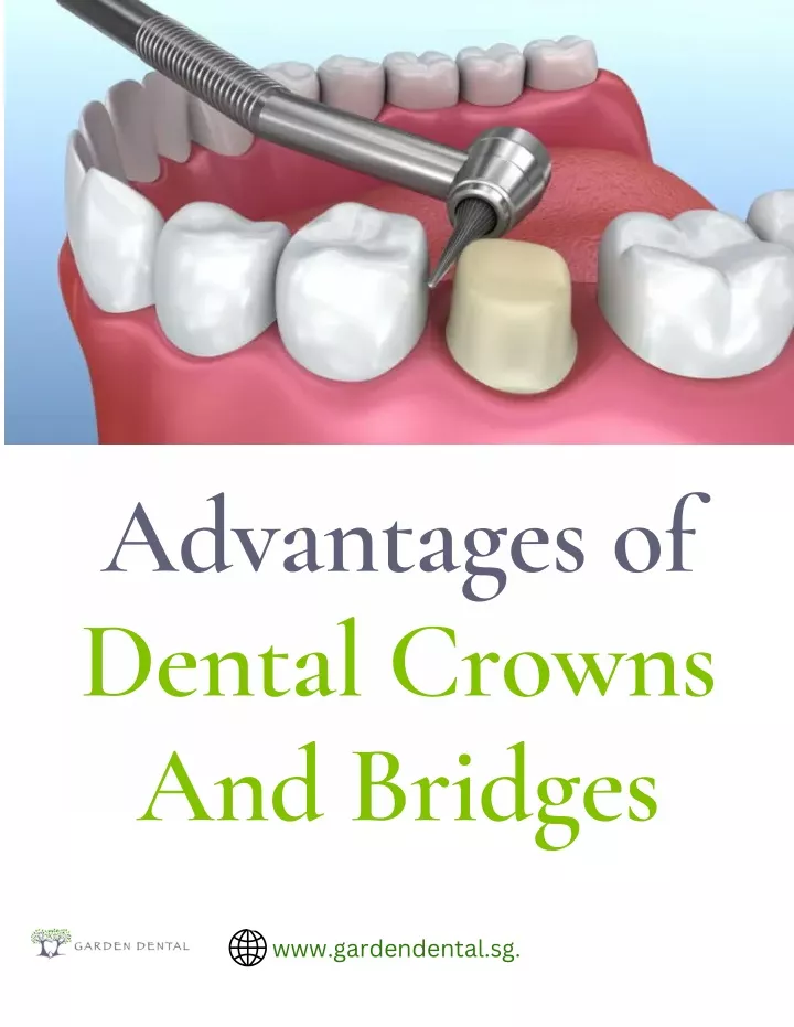 advantages of dental crowns and bridges