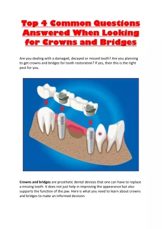 Top 4 Common Questions Answered When Looking for Crowns and Bridges