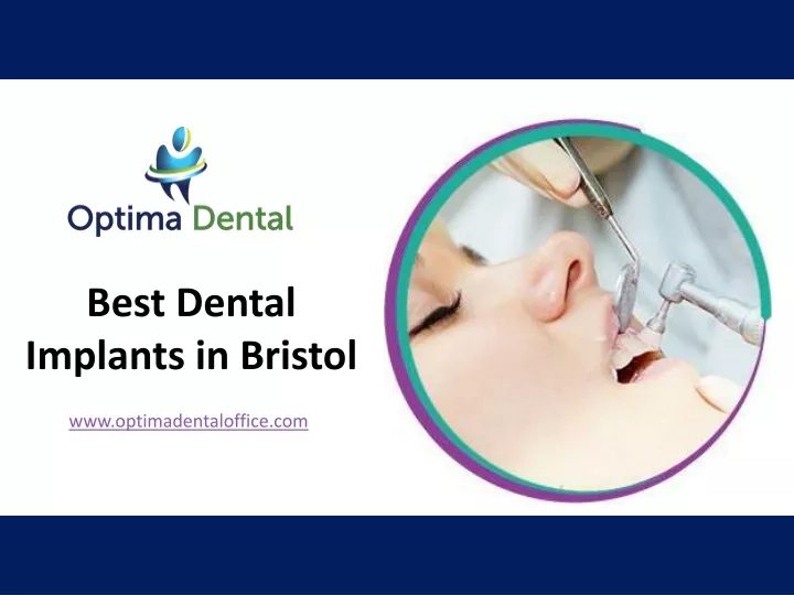 best dental implants in bristol