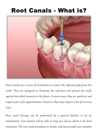 root canals what is