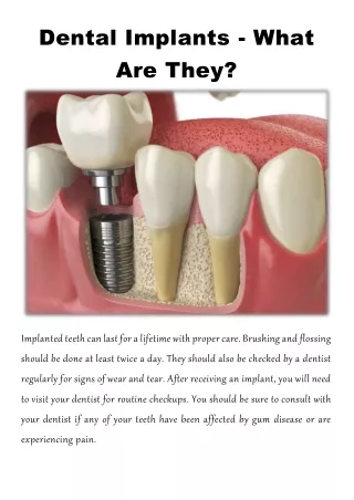 dental implants what are they