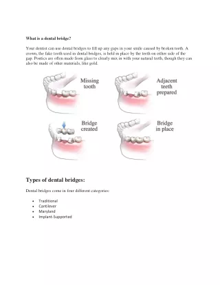 What is a dental bridge