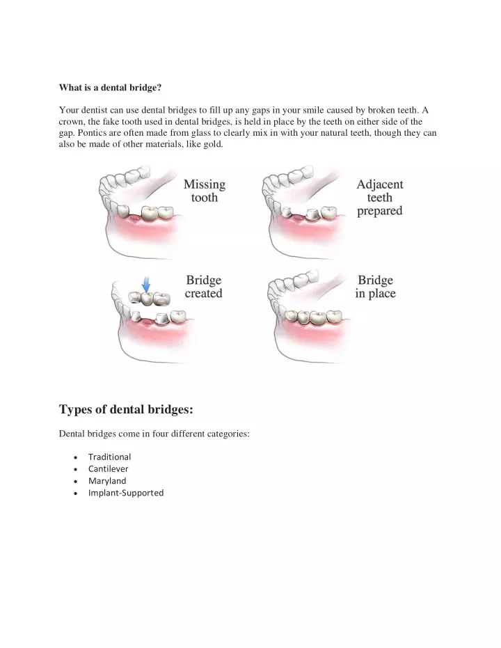 what is a dental bridge