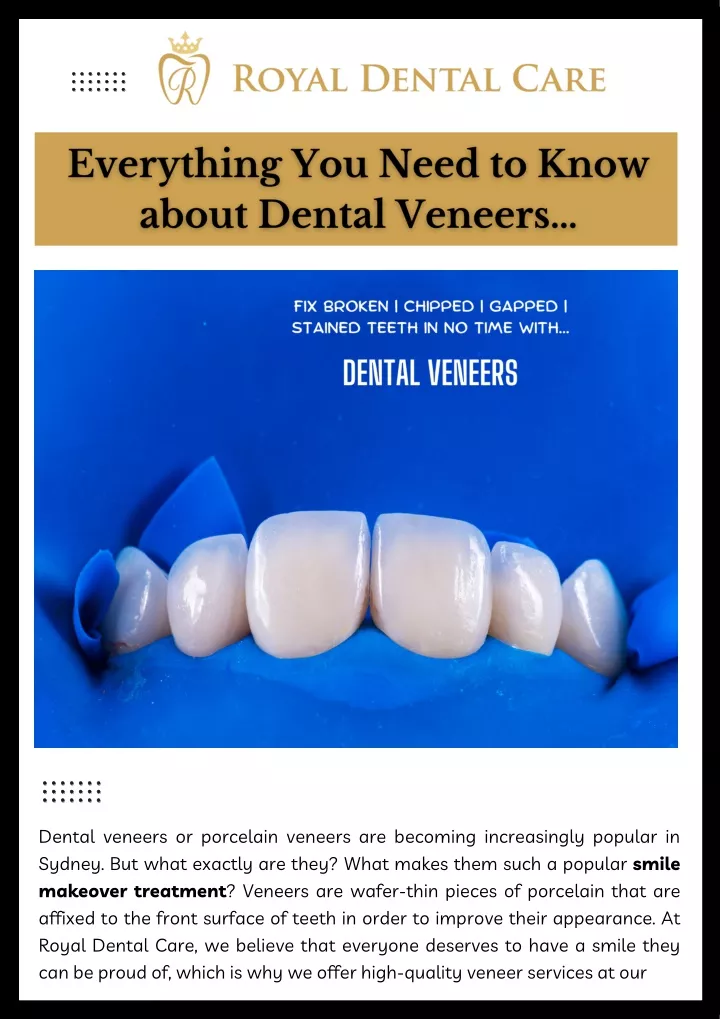 dental veneers or porcelain veneers are becoming