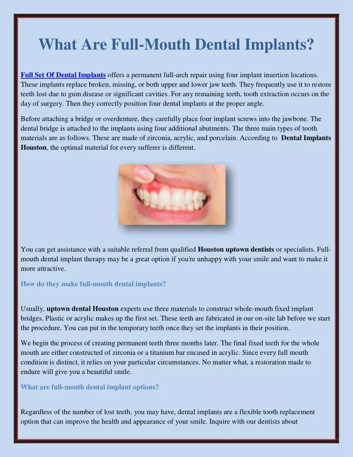 what are full mouth dental implants