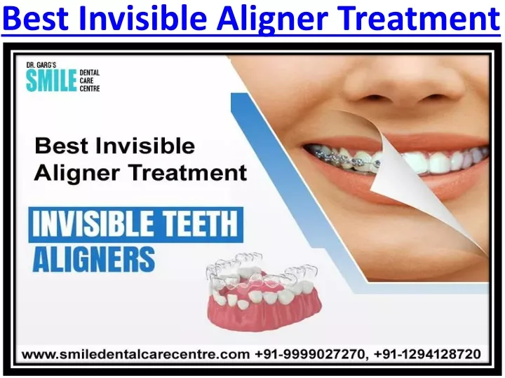 best invisible aligner treatment