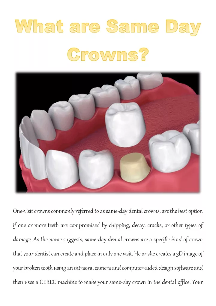 one visit crowns commonly referred to as same