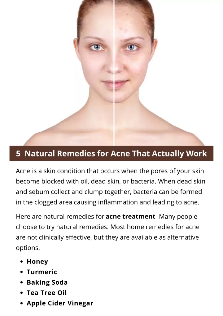 5 natural remedies for acne that actually work