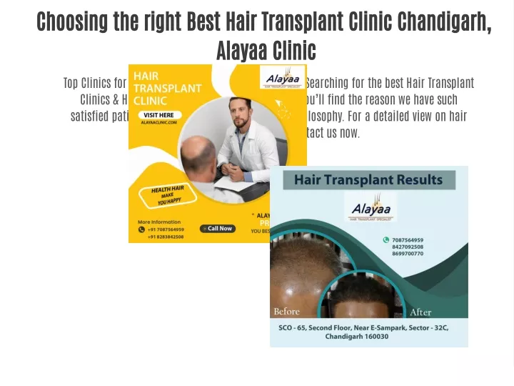 choosing the right best hair transplant clinic