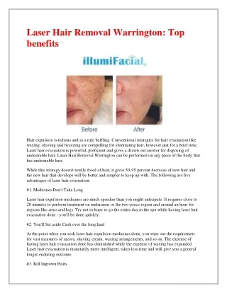 laser hair removal warrington top benefits