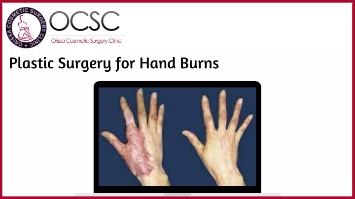 plastic surgery for hand burns