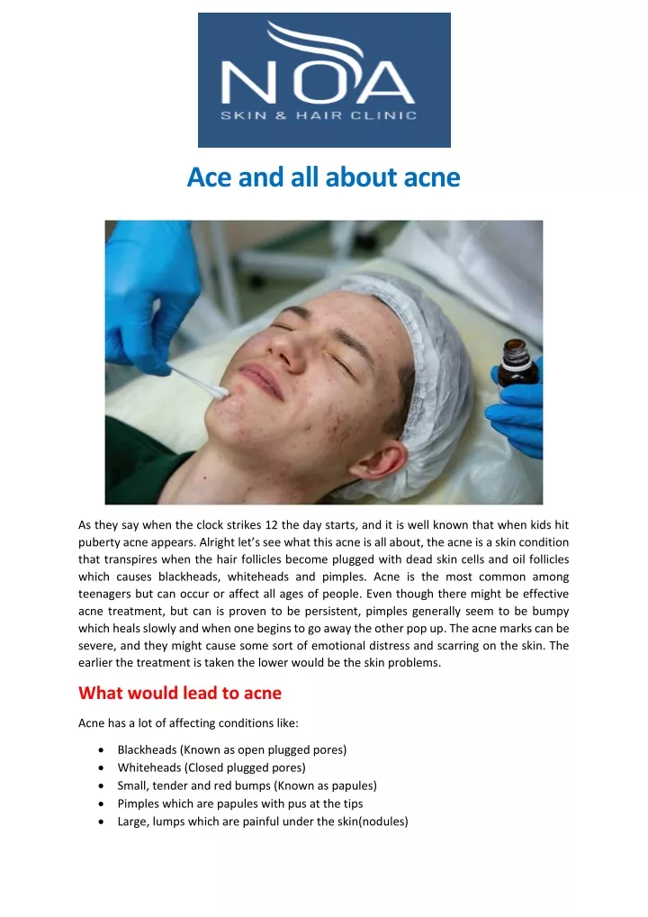 ace and all about acne