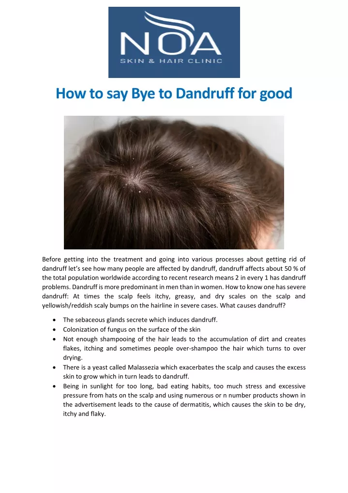 how to say bye to dandruff for good