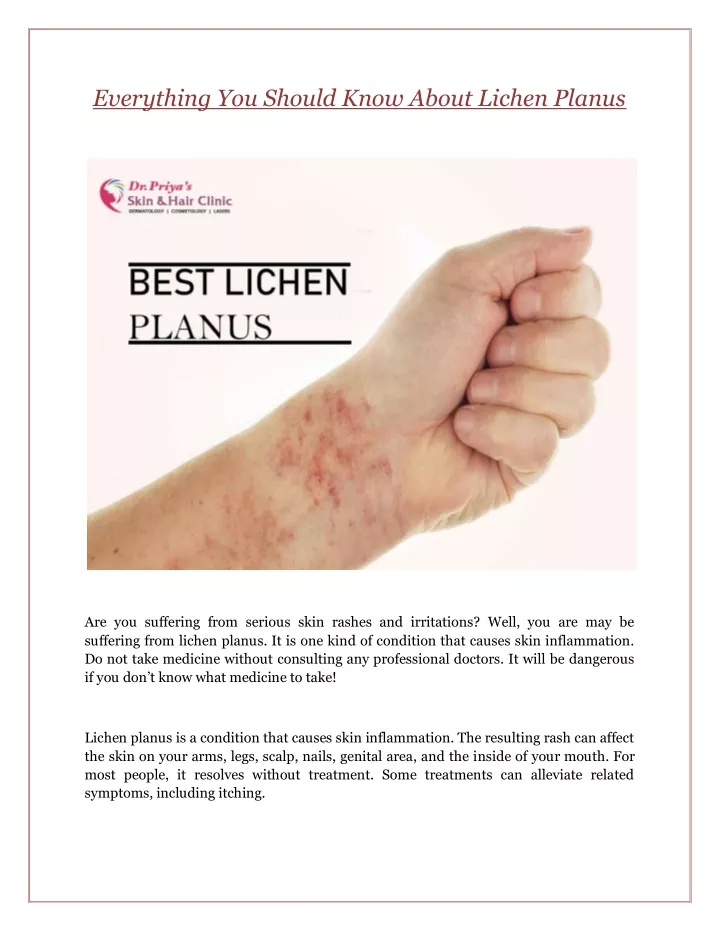 everything you should know about lichen planus