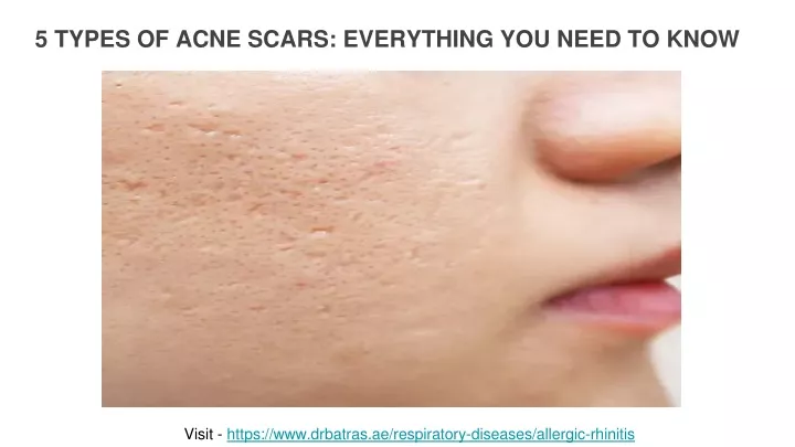 5 types of acne scars everything you need to know