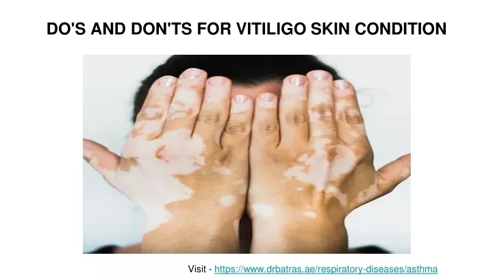 do s and don ts for vitiligo skin condition