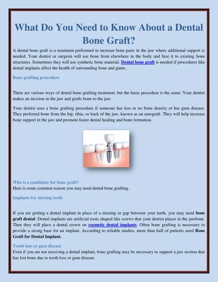 what do you need to know about a dental bone