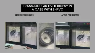 transjugular liver biopsy in a case with ehpvo