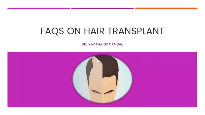 faqs on hair transplant