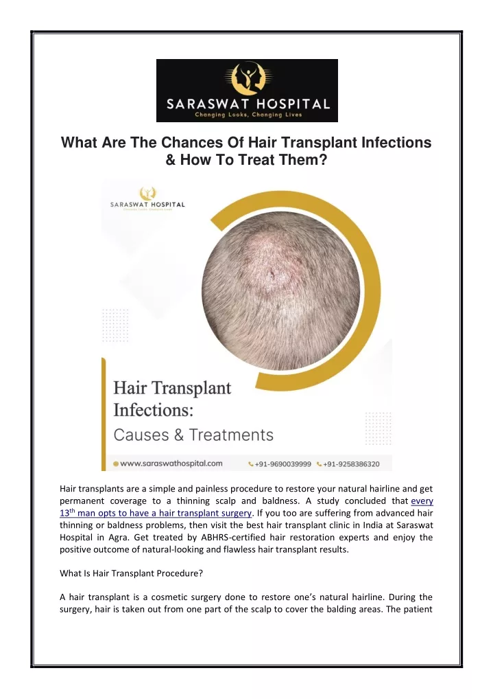 what are the chances of hair transplant