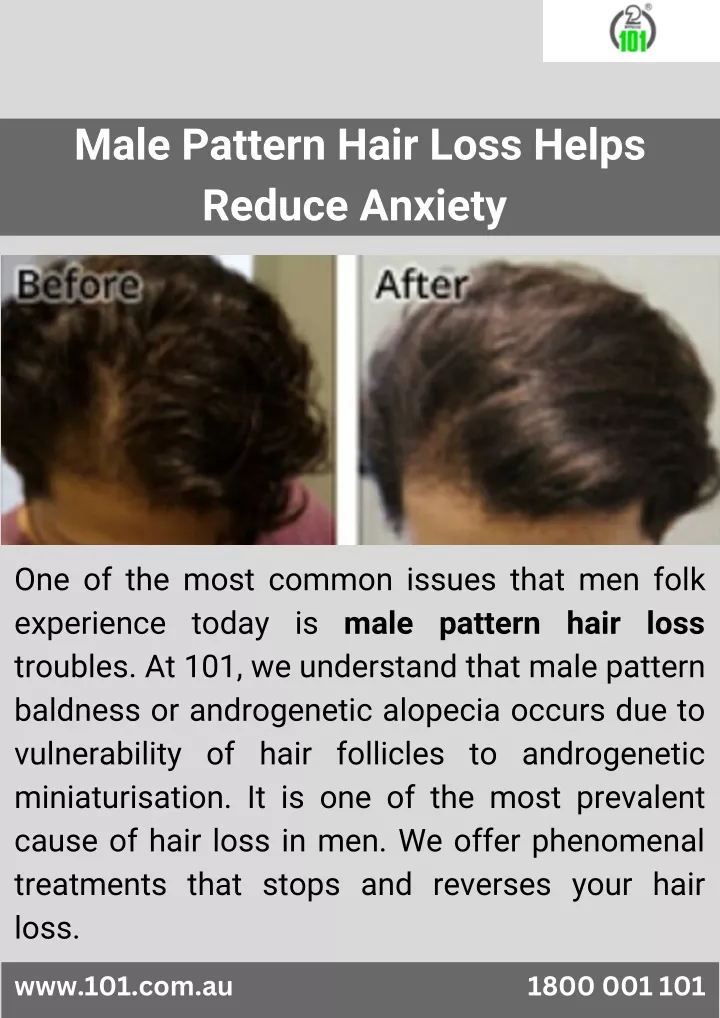 male pattern hair loss helps reduce anxiety