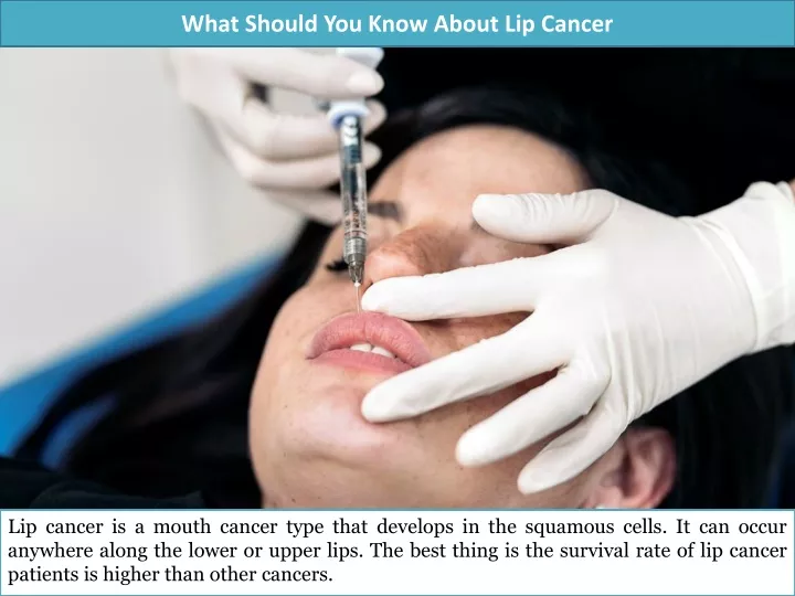 what should you know about lip cancer
