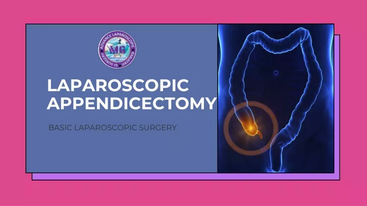 laparoscopic appendicectomy